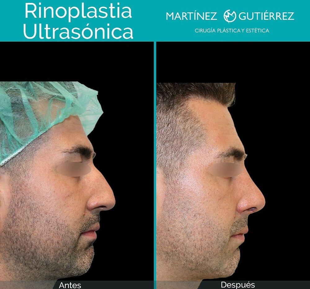 Before and After Result